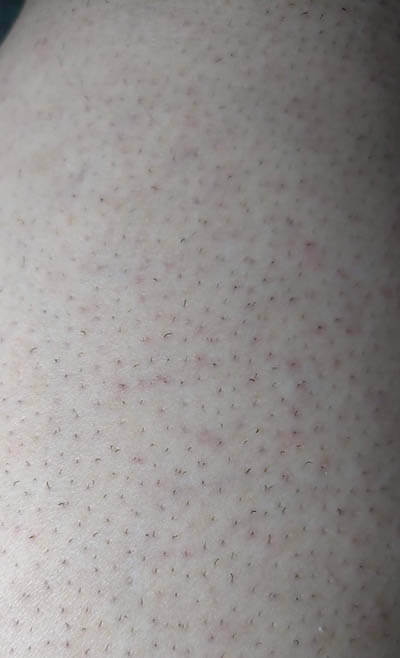 脱毛して赤くなった脚
