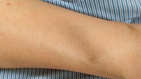 ケノン脱毛器で腕毛を1か月脱毛した写真 薄くなる 生えなくなる